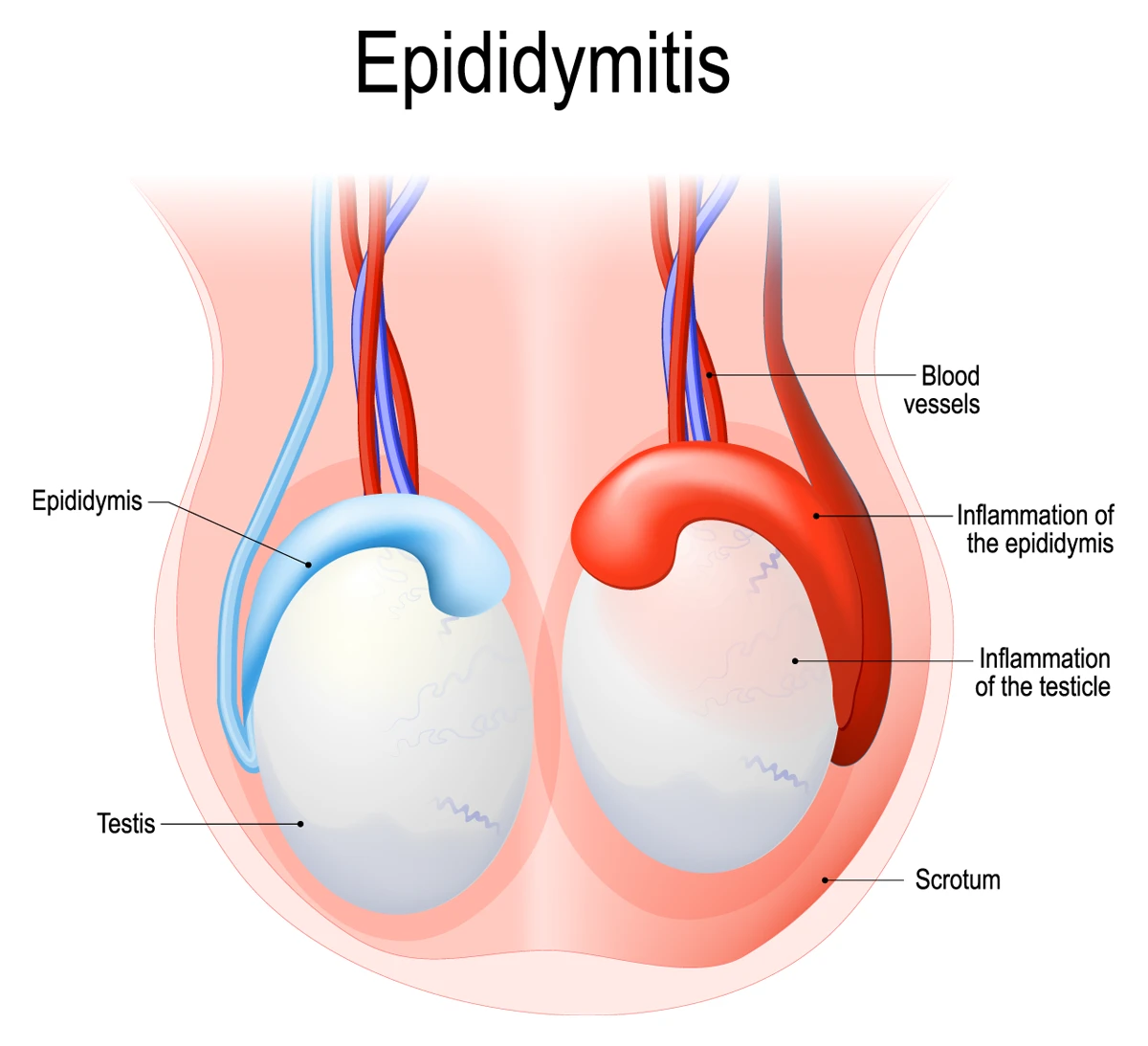 The image shows the inflammation of the epididymis, right, and a healthy testicle, left.