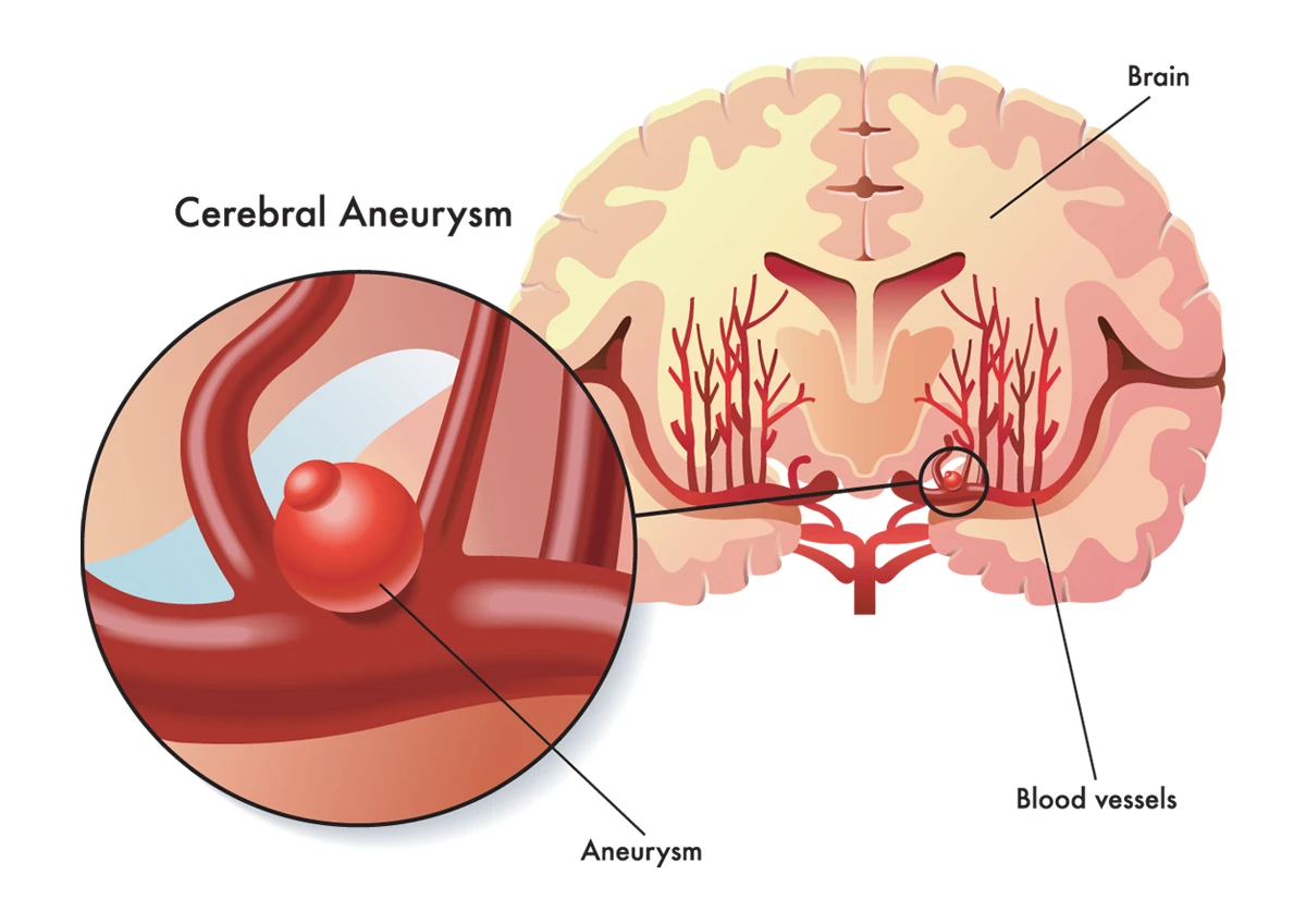 A brain aneurysm is a ballooning blood vessel, as shown in the image above.