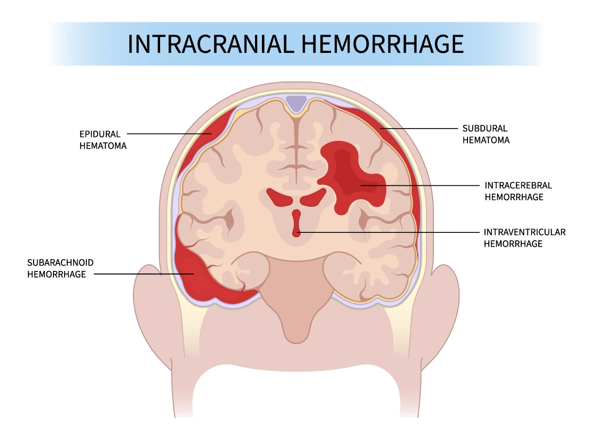 Intracranial