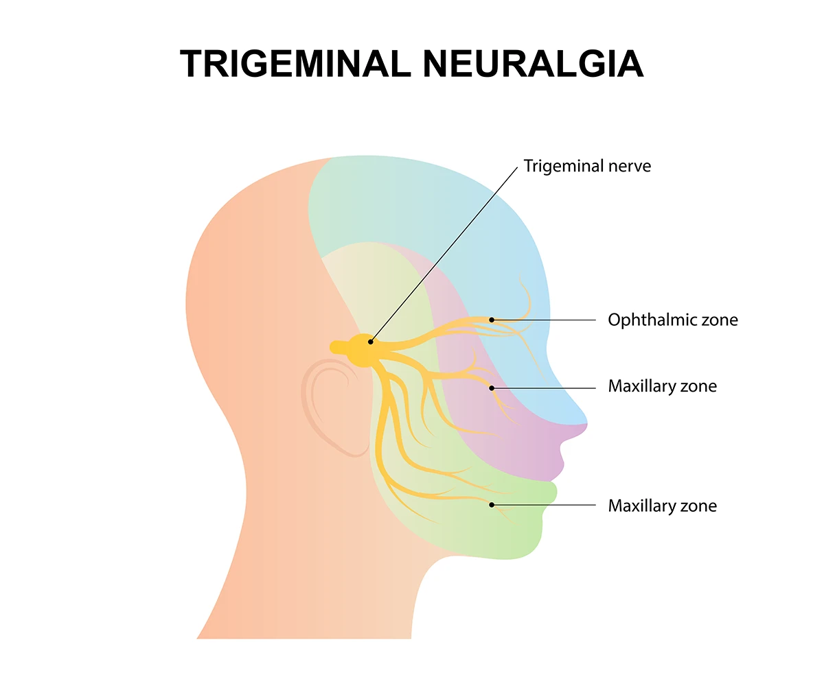 The trigeminal nerve reaches three zones of the face. In cases of trigeminal neuralgia, severe pain can be felt in any of the three zones.
