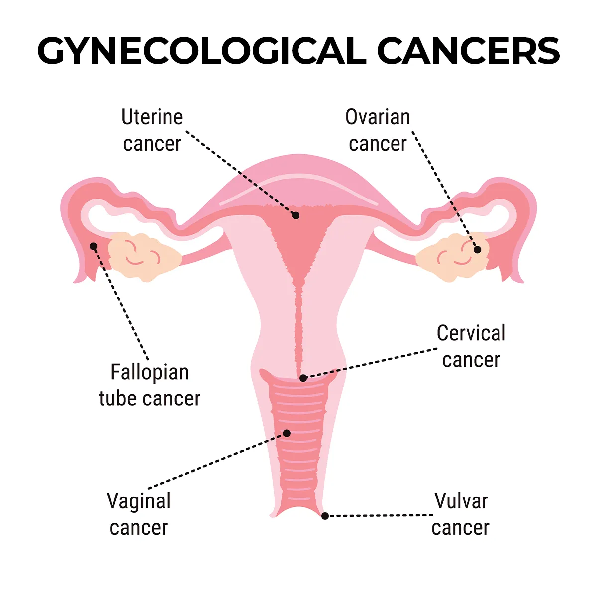 Image shows the location of each of the following types of gynecologic cancers; uterine cancer, ovarian cancer, fallopian tube cancer, cervical cancer, vaginal cancer and vulvar cancer.