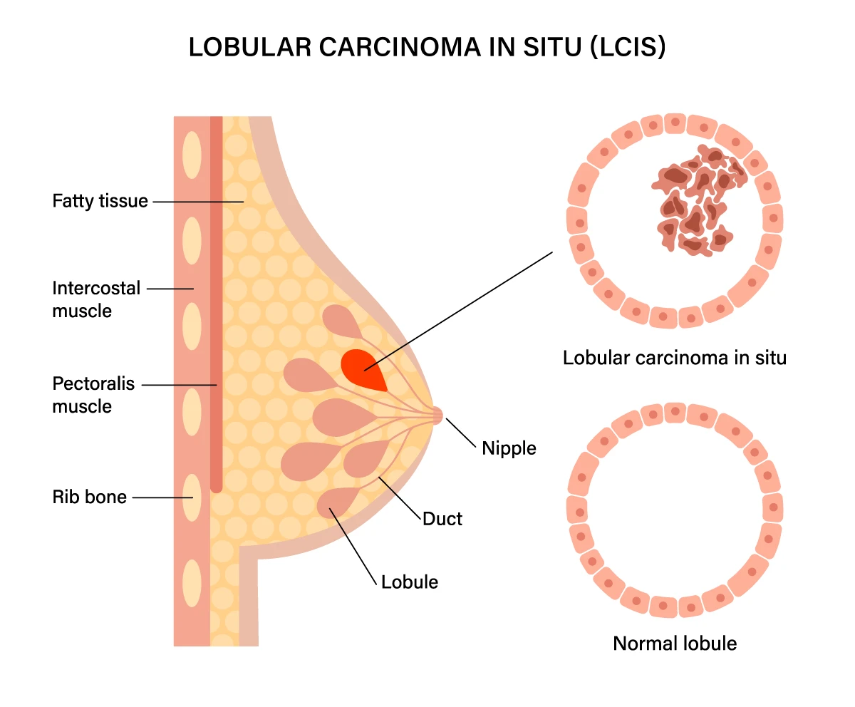 The image shows the anatomy of the breast and gives a comparison of a normal milk gland and one that has lobular carcinoma in situ, or LCIS.