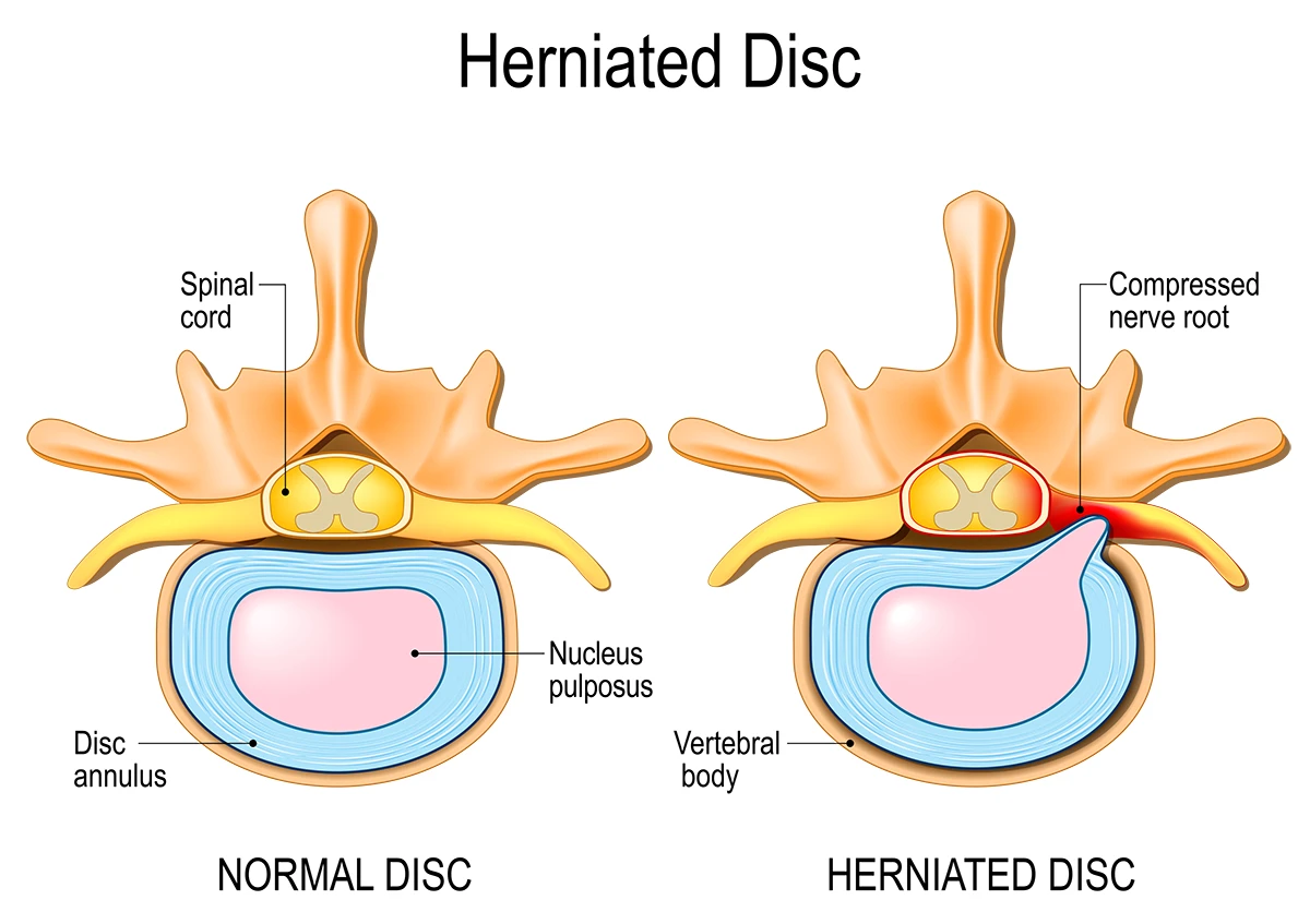 En una hernia de disco, la inflamación hace que la pulpa dentro del disco de la vértebra sobresalga y comprima el nervio de la médula espinal.