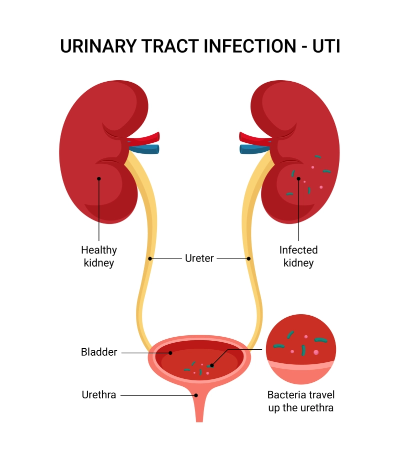 Image shows an anatomical breakdown of a urinary tract infection (UTI).